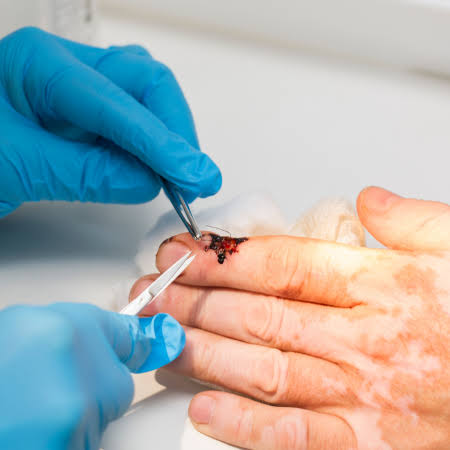Vitiligo surgery nail surgery Saharanpur skin doctor